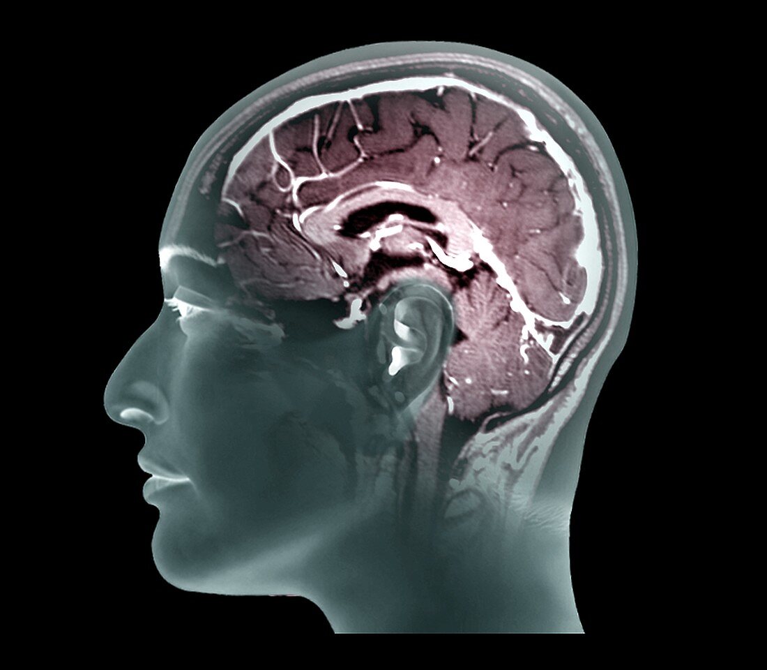 Thrombophlebitis of the brain, MRI scan