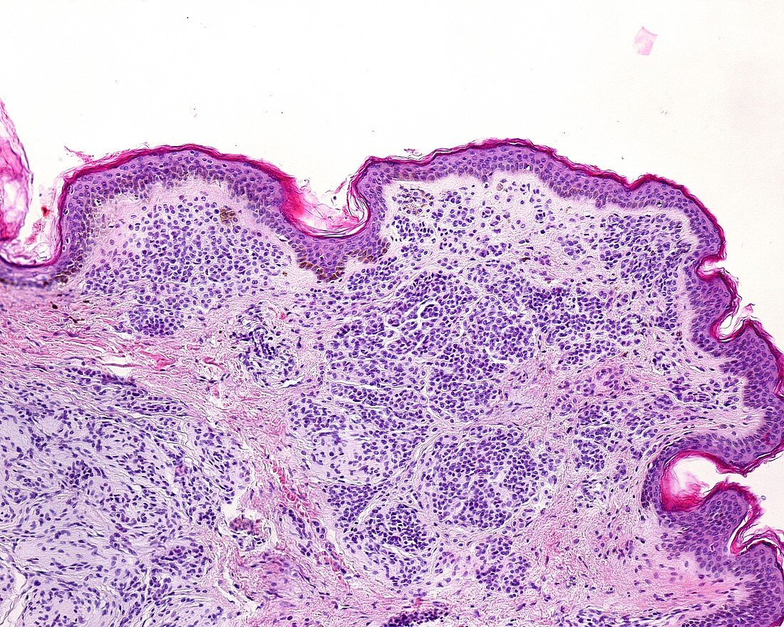 Skin nevus, light micrograph