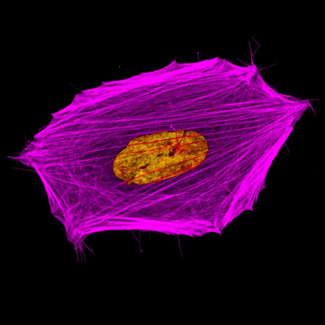 Cancer cell cytoskeleton and nuclei, light micrograph