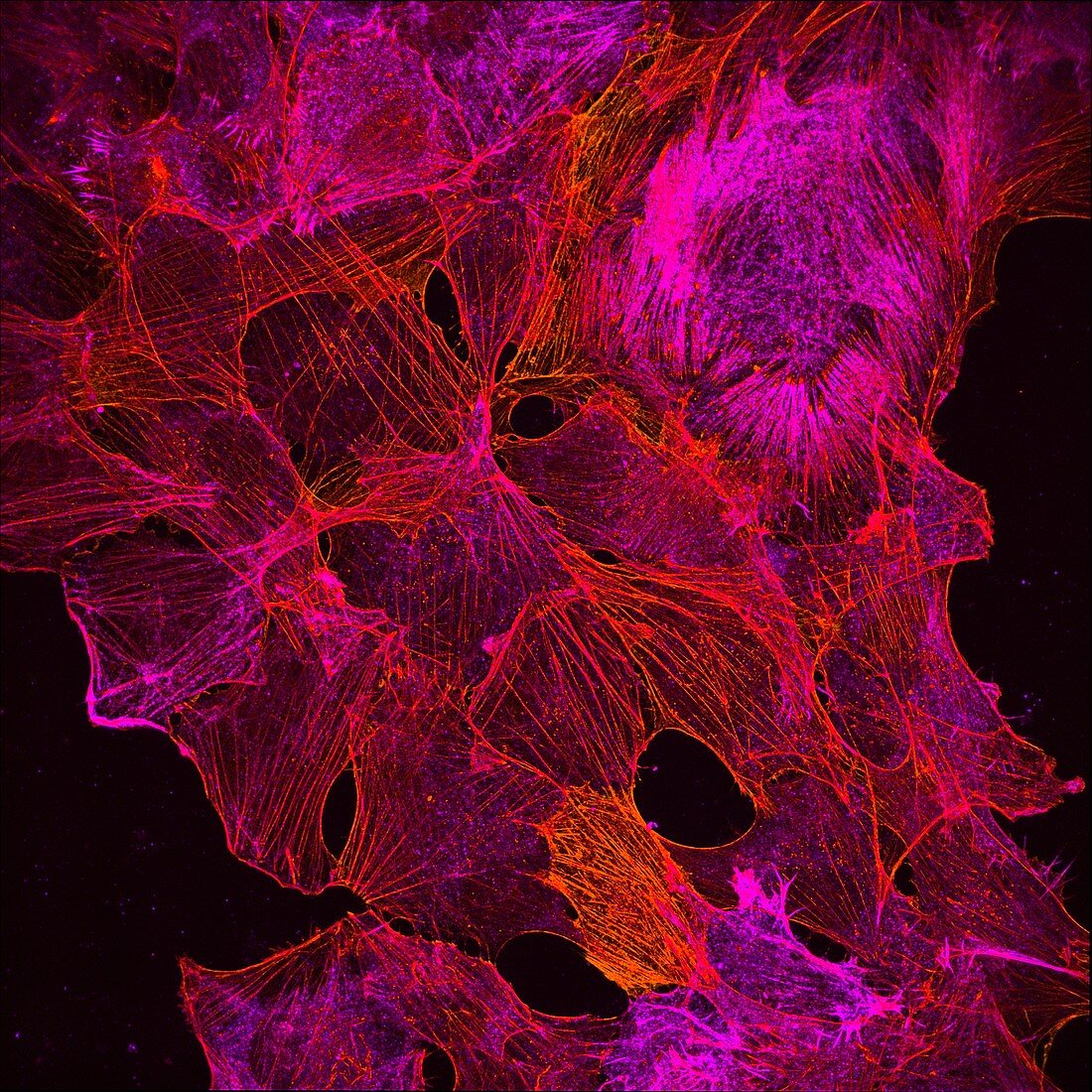 Cancer cells showing actin cytoskeleton, light micrograph