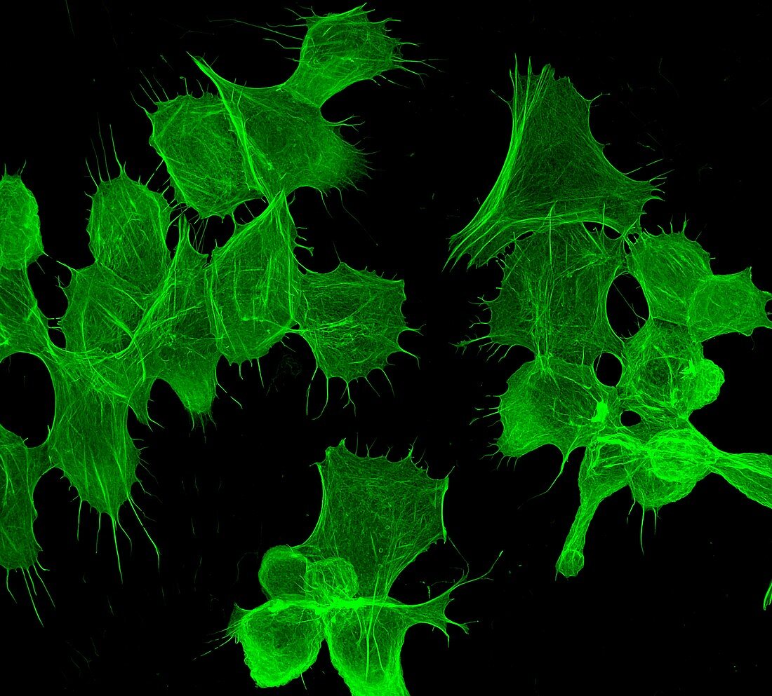 Dying cancer cells showing cytoskeleton, light micrograph
