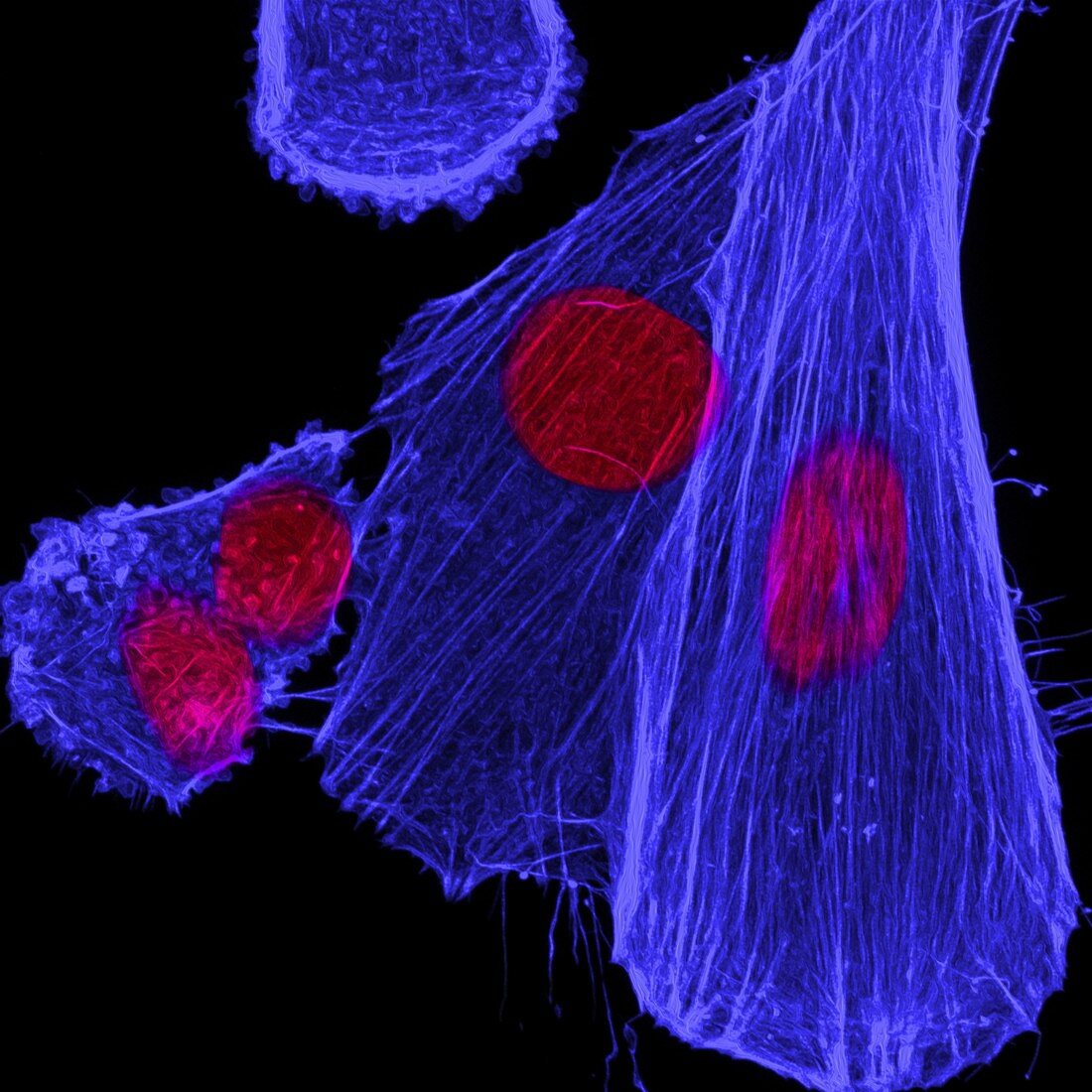 Neuroblastoma nuclei and cytoskeleton, light micrograph