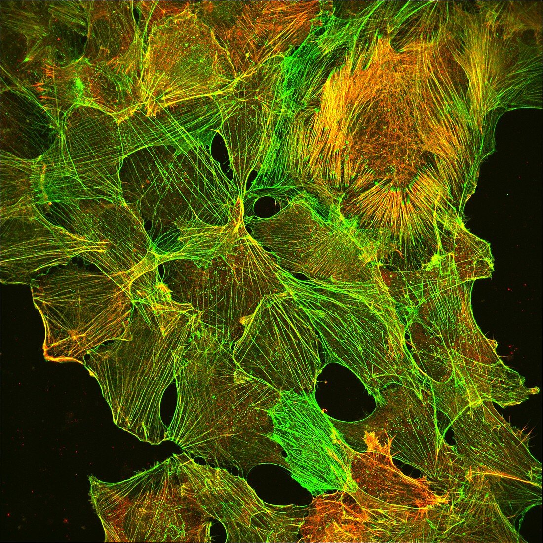 Neuroblastoma showing cytoskeleton, light micrograph