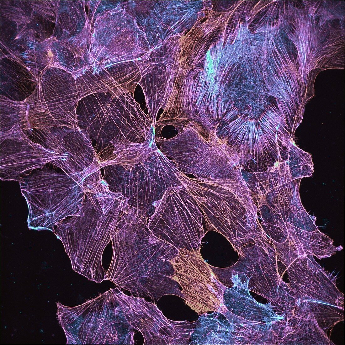 Cultured cancer cells cytoskeleton, light micrograph