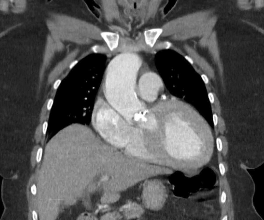 Calcified heart valve, CT scan