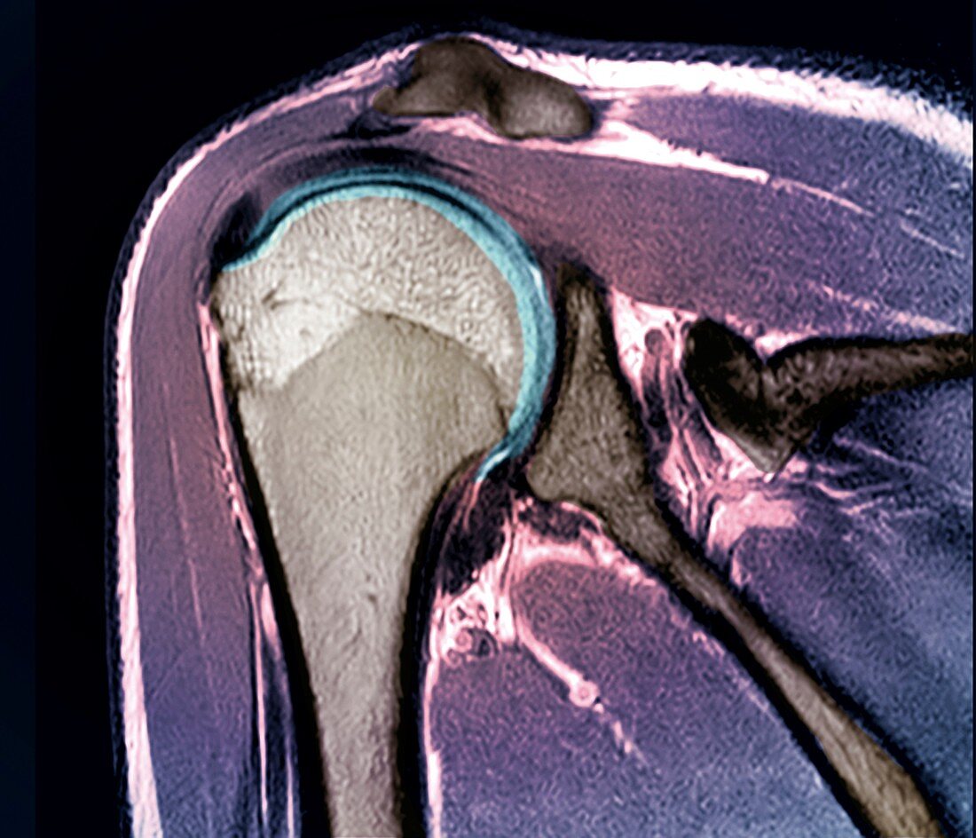 Healthy shoulder joint, MRI scan