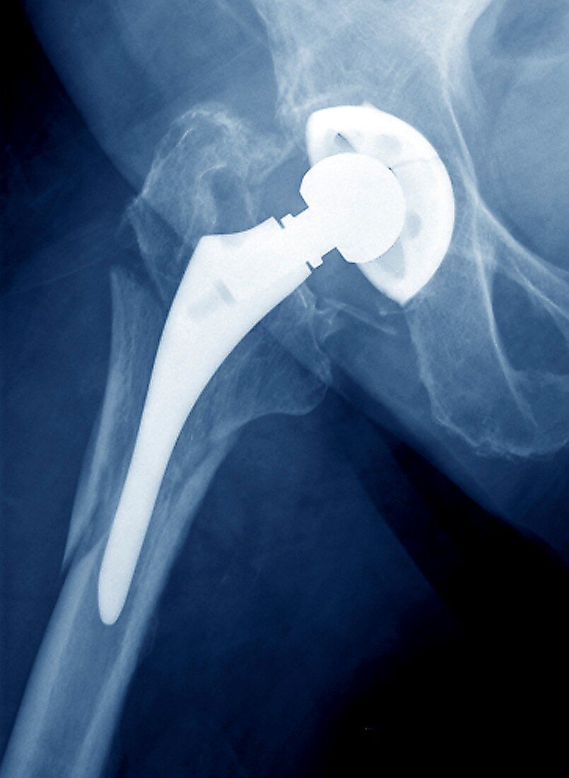 Fractured thigh bone, X-ray