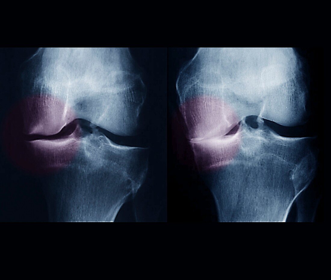 Knee osteoarthritis, X-rays