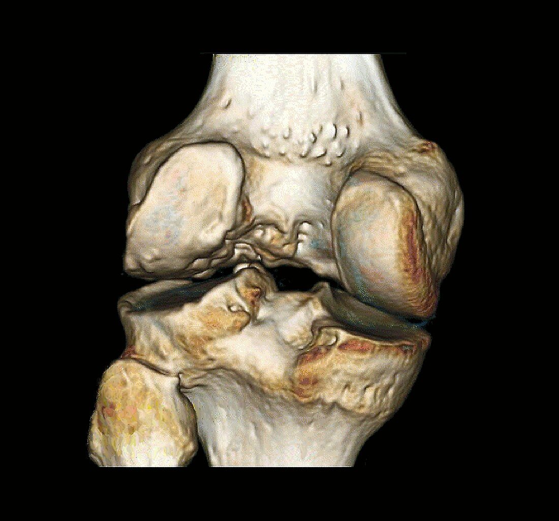 Healthy knee, CT scan