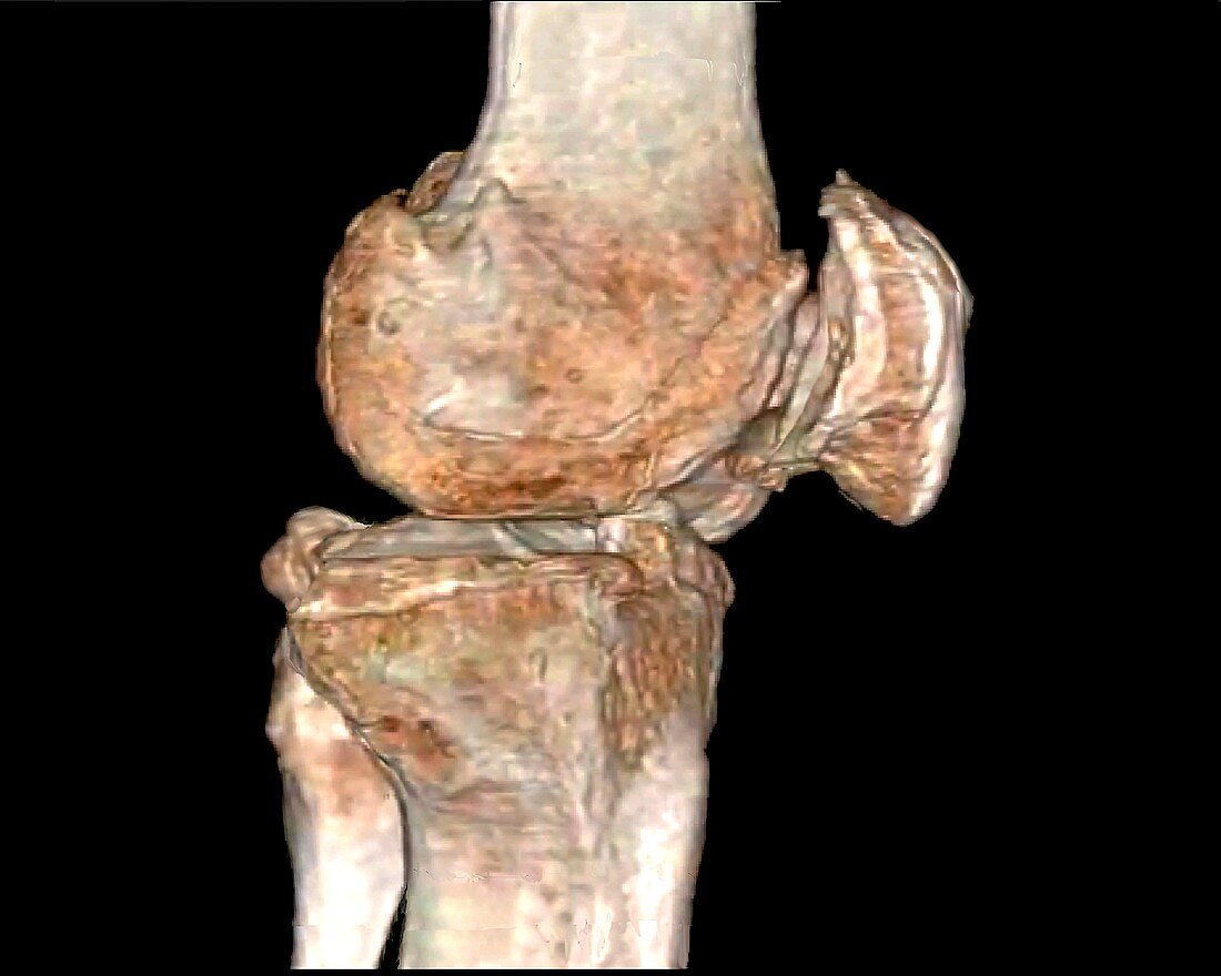 Knee osteoarthritis, CT scan
