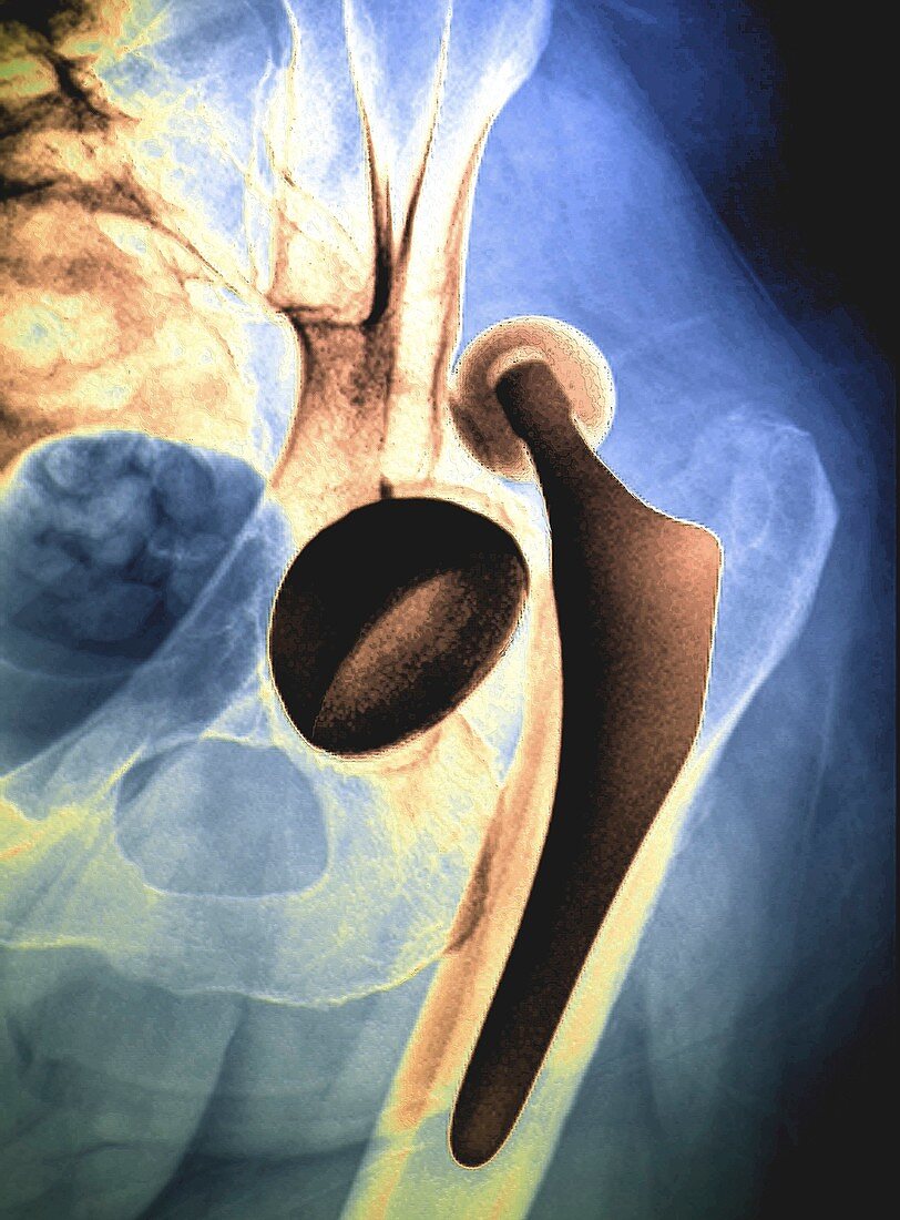 Dislocated hip replacement, X-ray