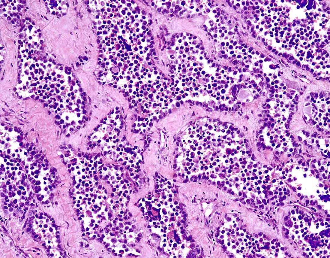 Alveolar rhabdomyosarcoma, light micrograph