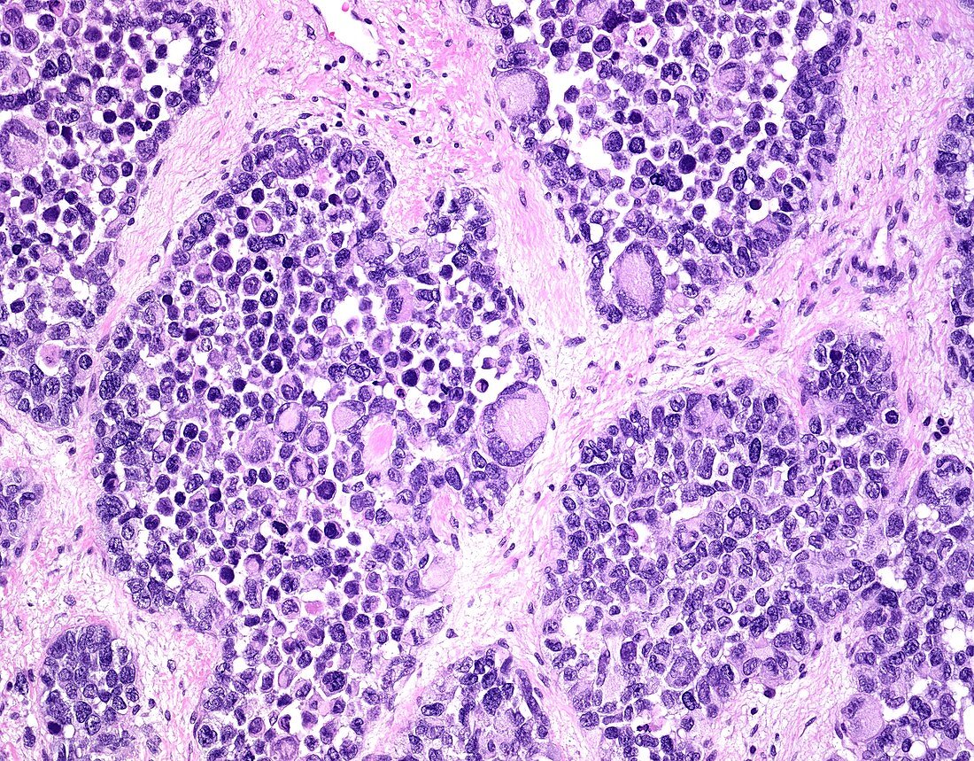 Alveolar rhabdomyosarcoma, light micrograph