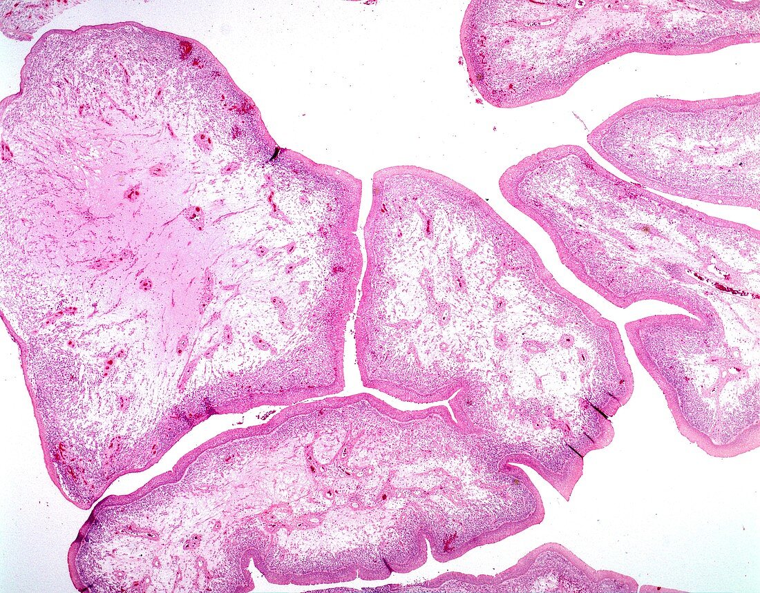 Botryoid rhabdomyosarcoma, light micrograph