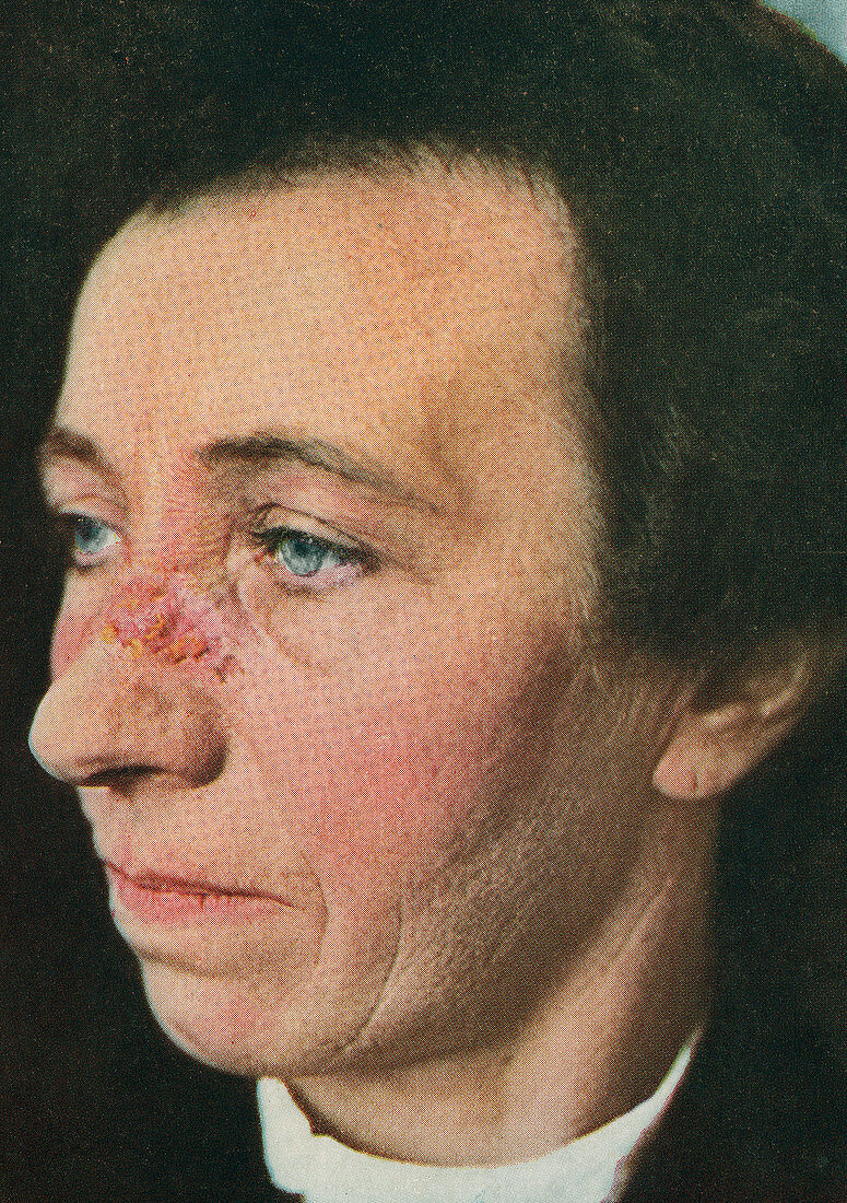 Lupus erythematosus, historical image