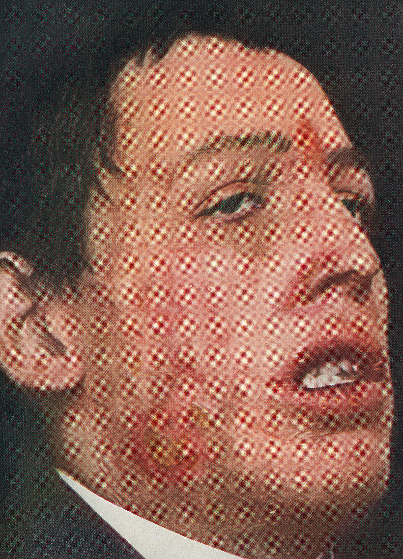 Cutaneous tuberculosis, historical image
