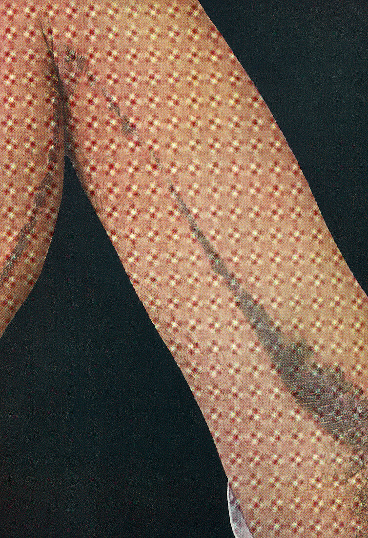 Linear epidermal naevus, historical image