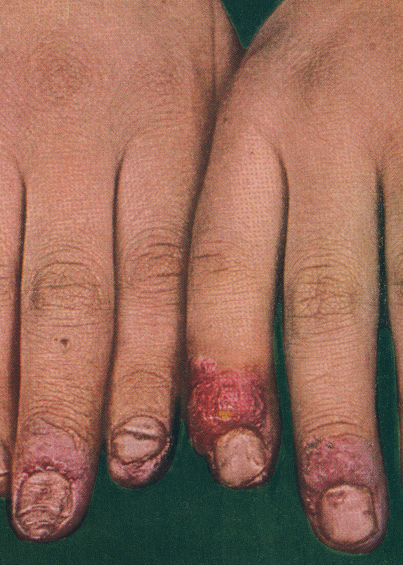 Paronychia infection, historical image