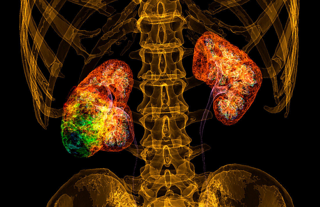 Kidney cancer, 3D CT scan