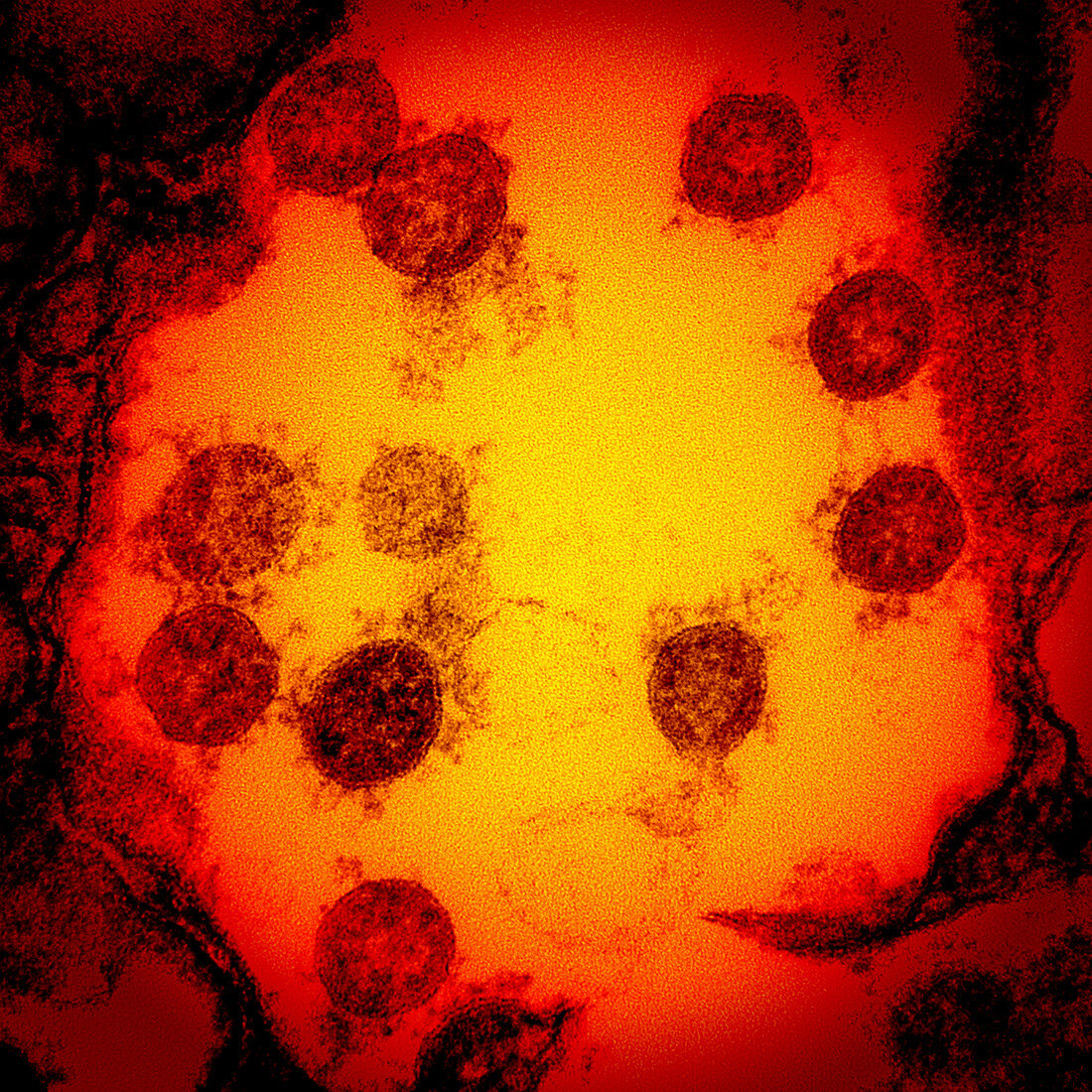 Covid-19 coronavirus particles, TEM
