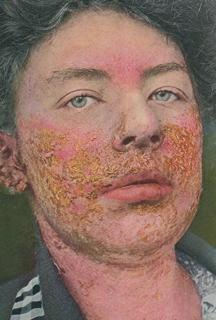 Eczema, historical image
