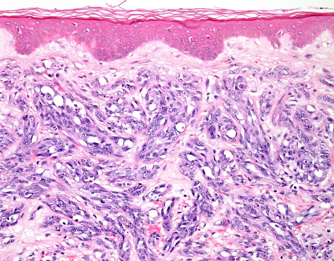 Angiosarcoma of skin, light micrograph