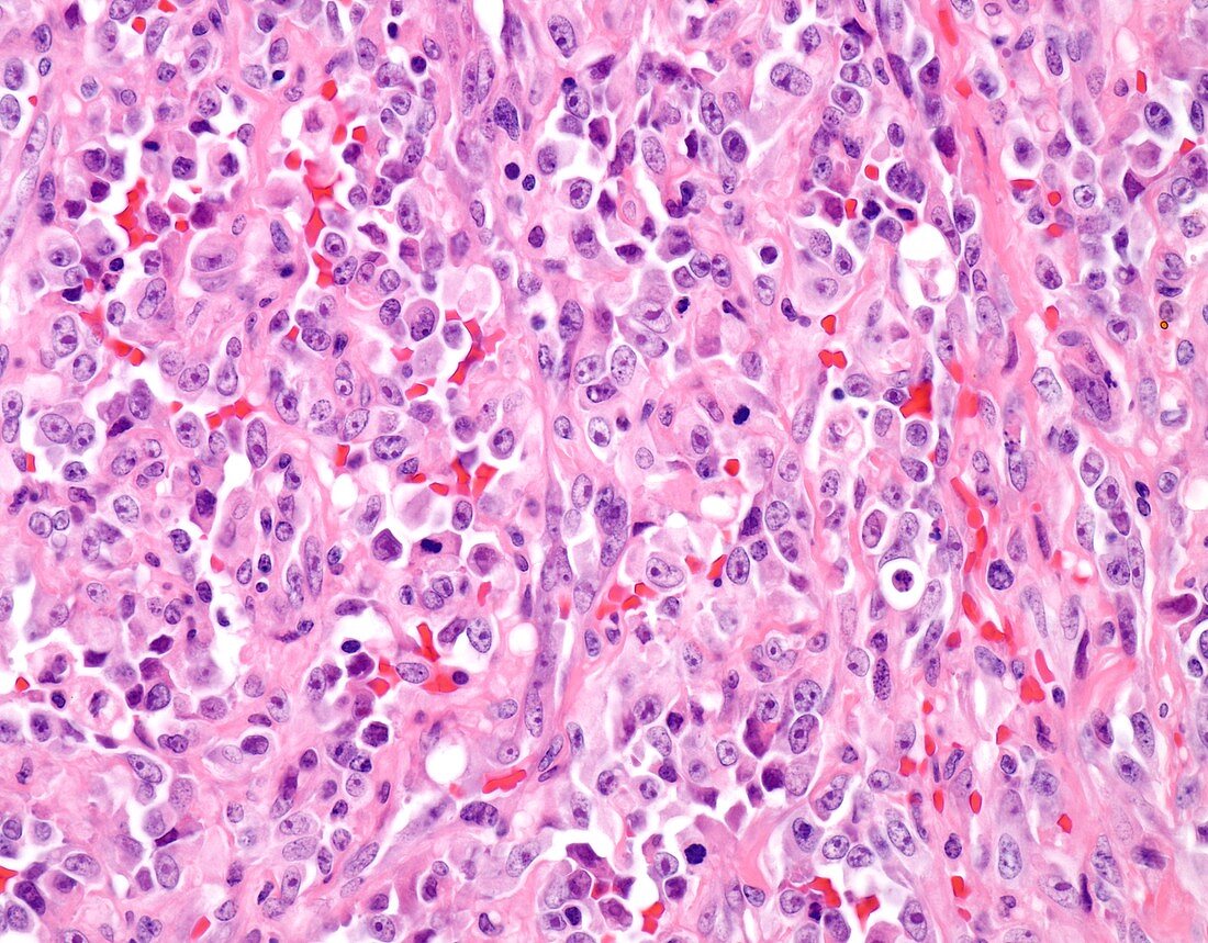 Epithelioid angiosarcoma of breast, light micrograph