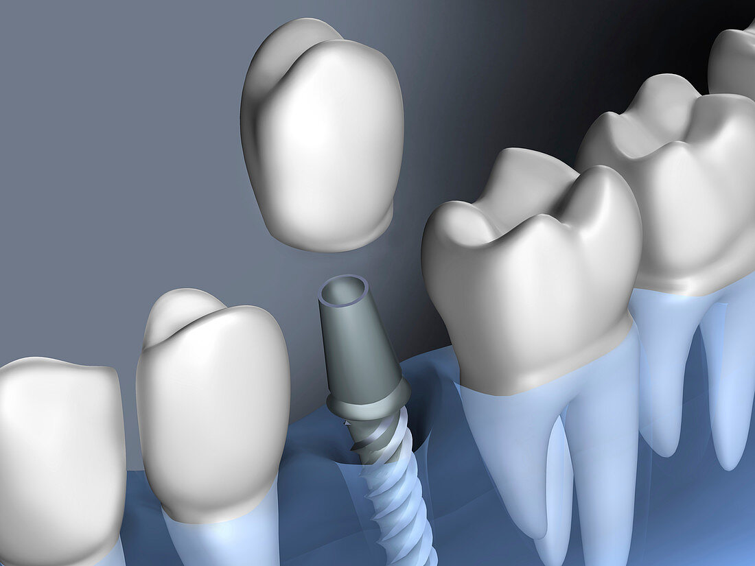 Inserting dental implant, illustration