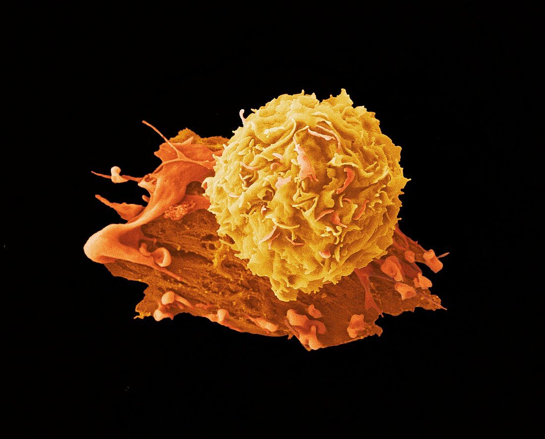 Breast cancer cell, SEM