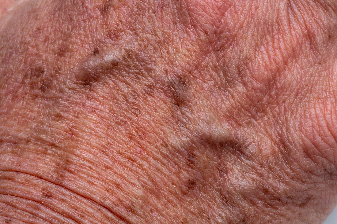 Age spots on elderly skin