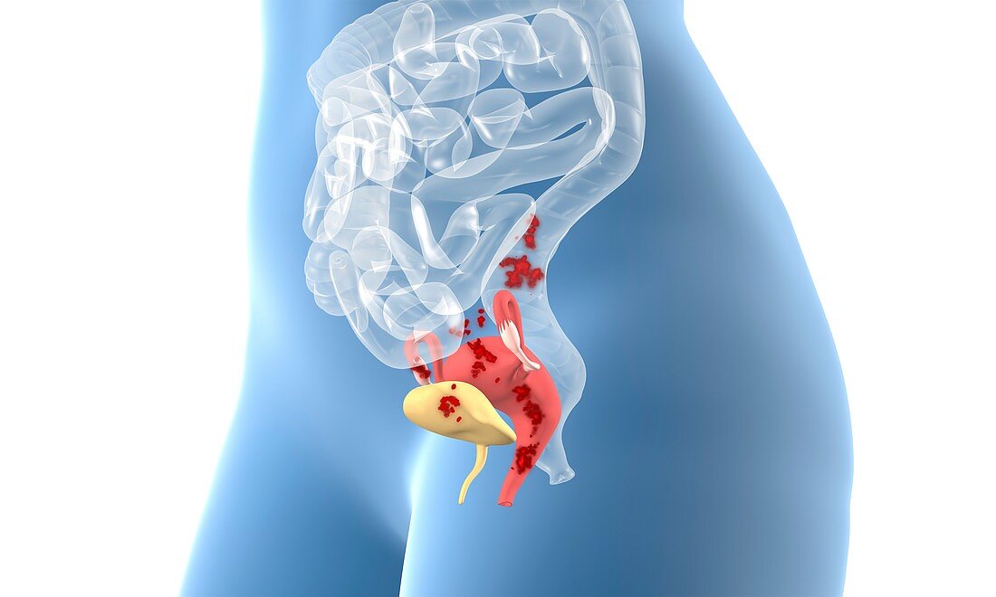 Endometriosis, 3D illustration