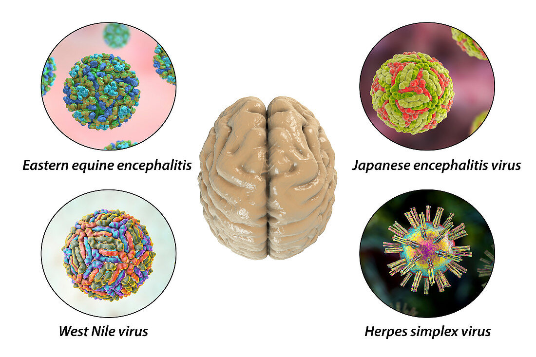 Brain infections, illustration