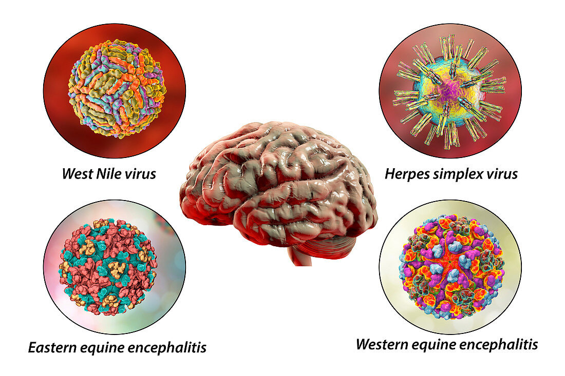 Brain infections, illustration