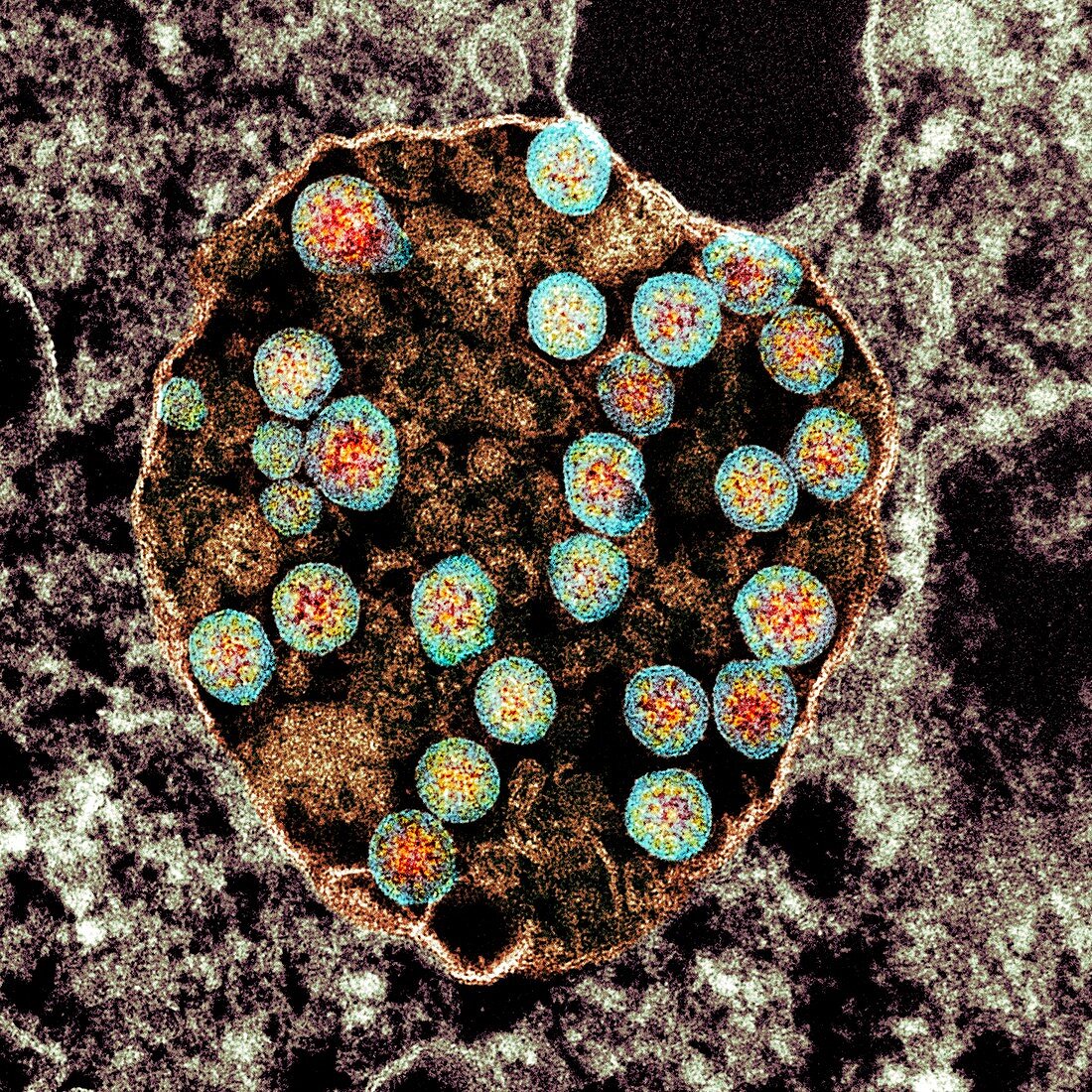 Cell infected with Covid-19 coronavirus particles, TEM