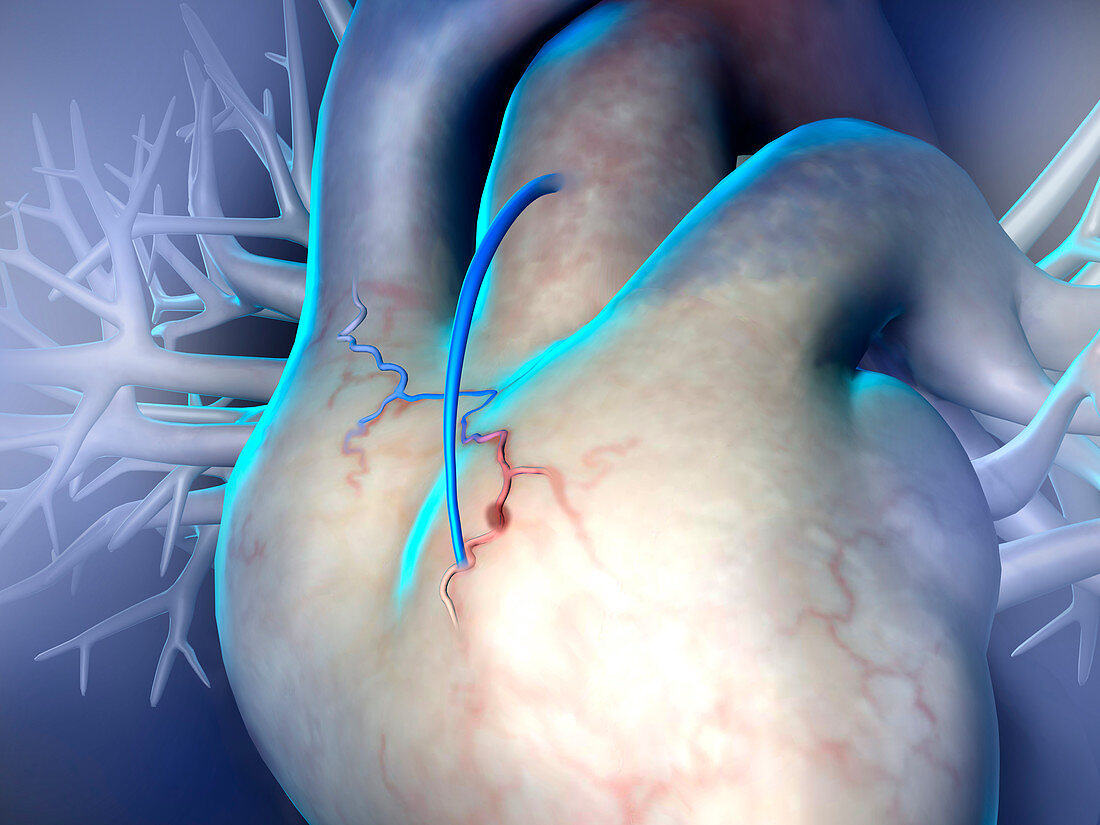 Heart bypass graft, illustration