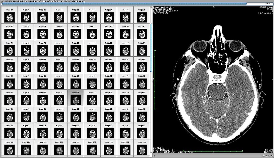 Human brain, CT scans