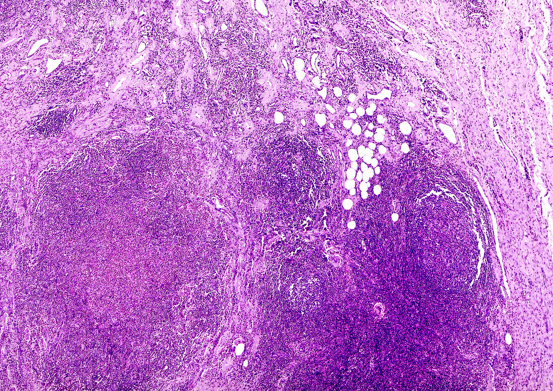 Human eosinophilic granuloma, light micrograph