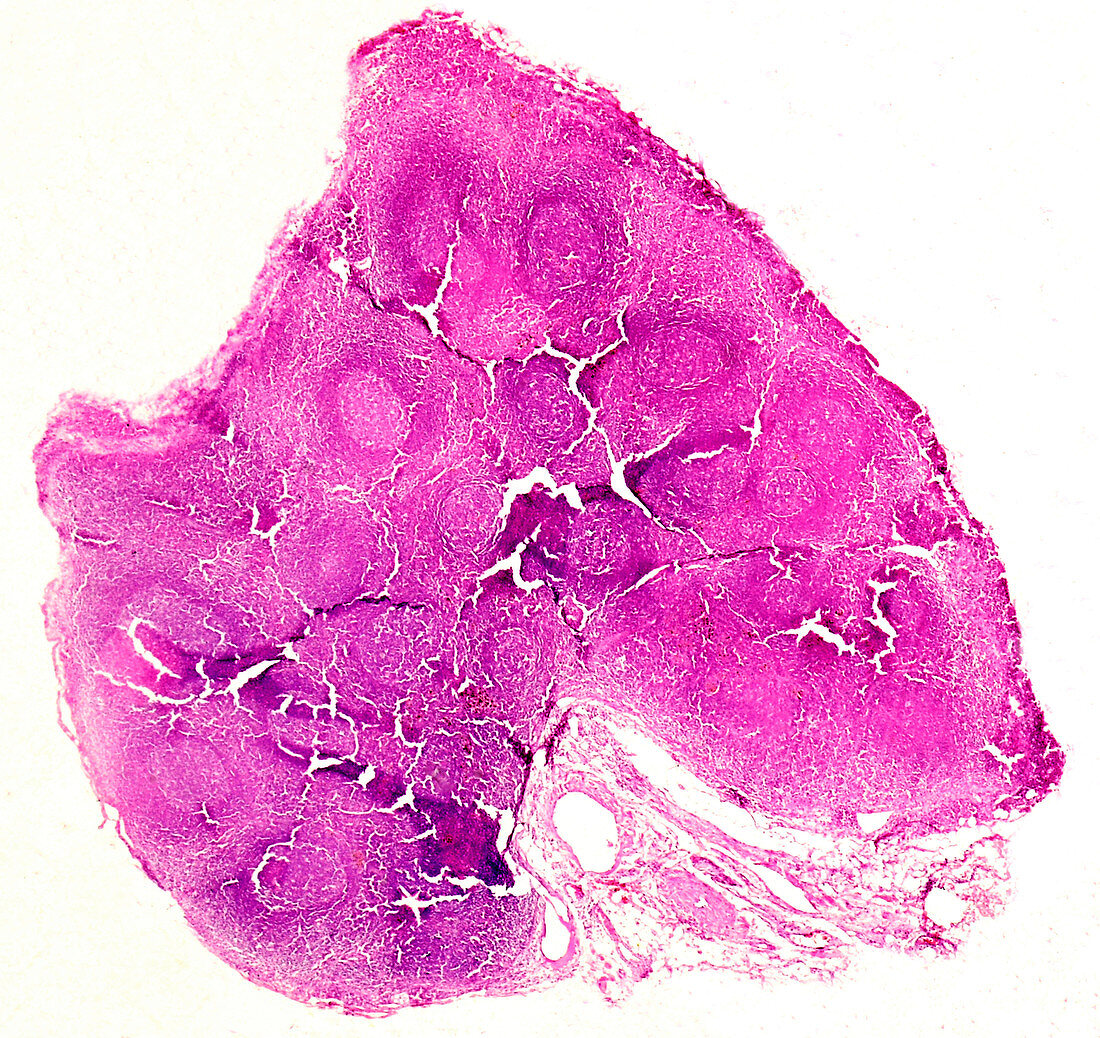 Lung silicosis, light micrograph