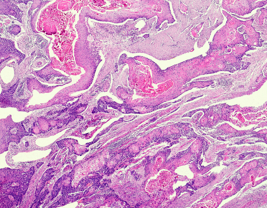 Carcinoma of the oesophagus, light micrograph
