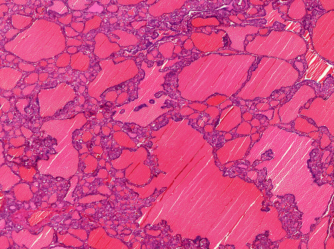 Thyroid adenoma, light micrograph