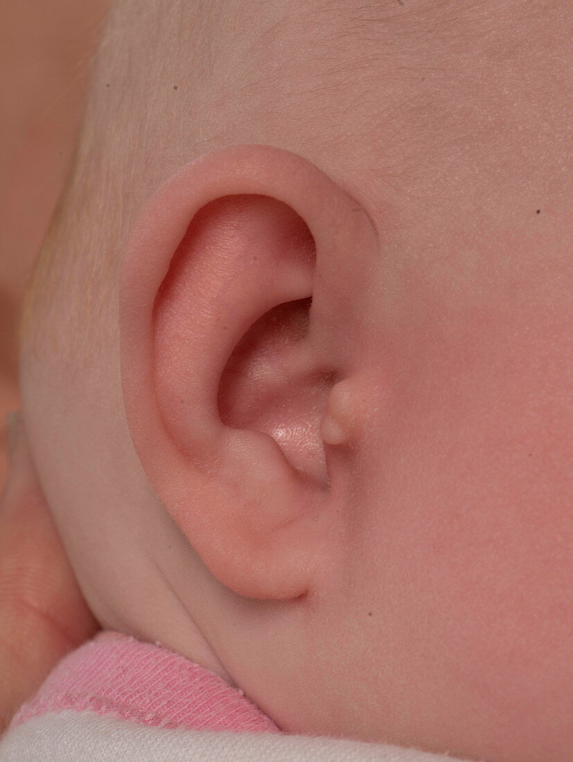 Accessory auricle ear deformity