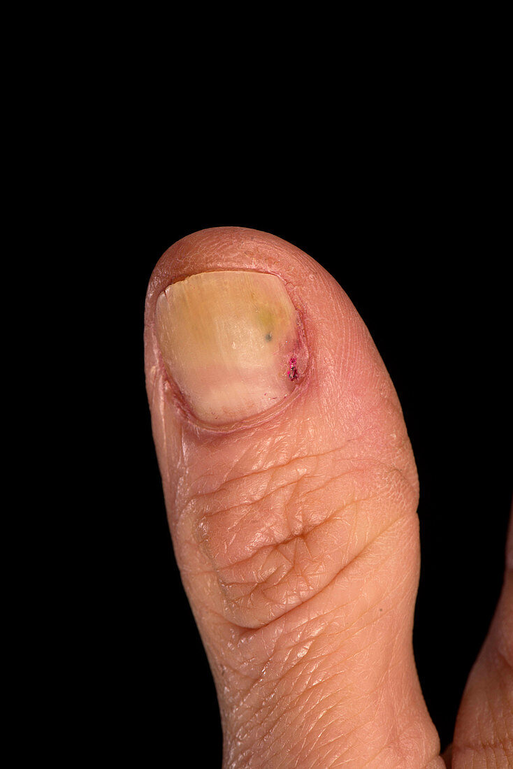 Fungal nail infection