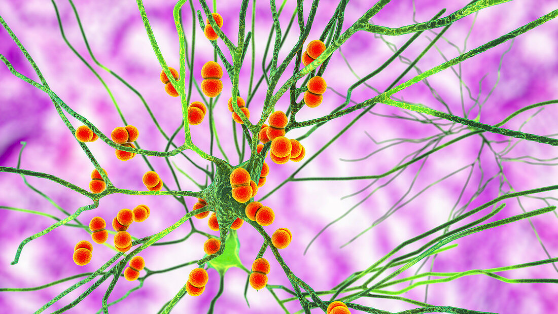Bacterial brain infection, illustration