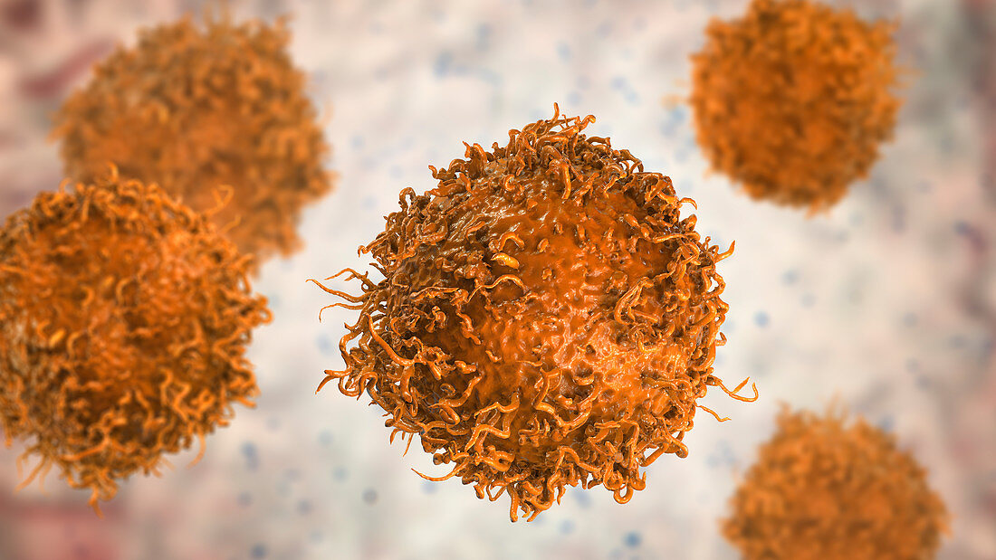 Stomach cancer cell, illustration