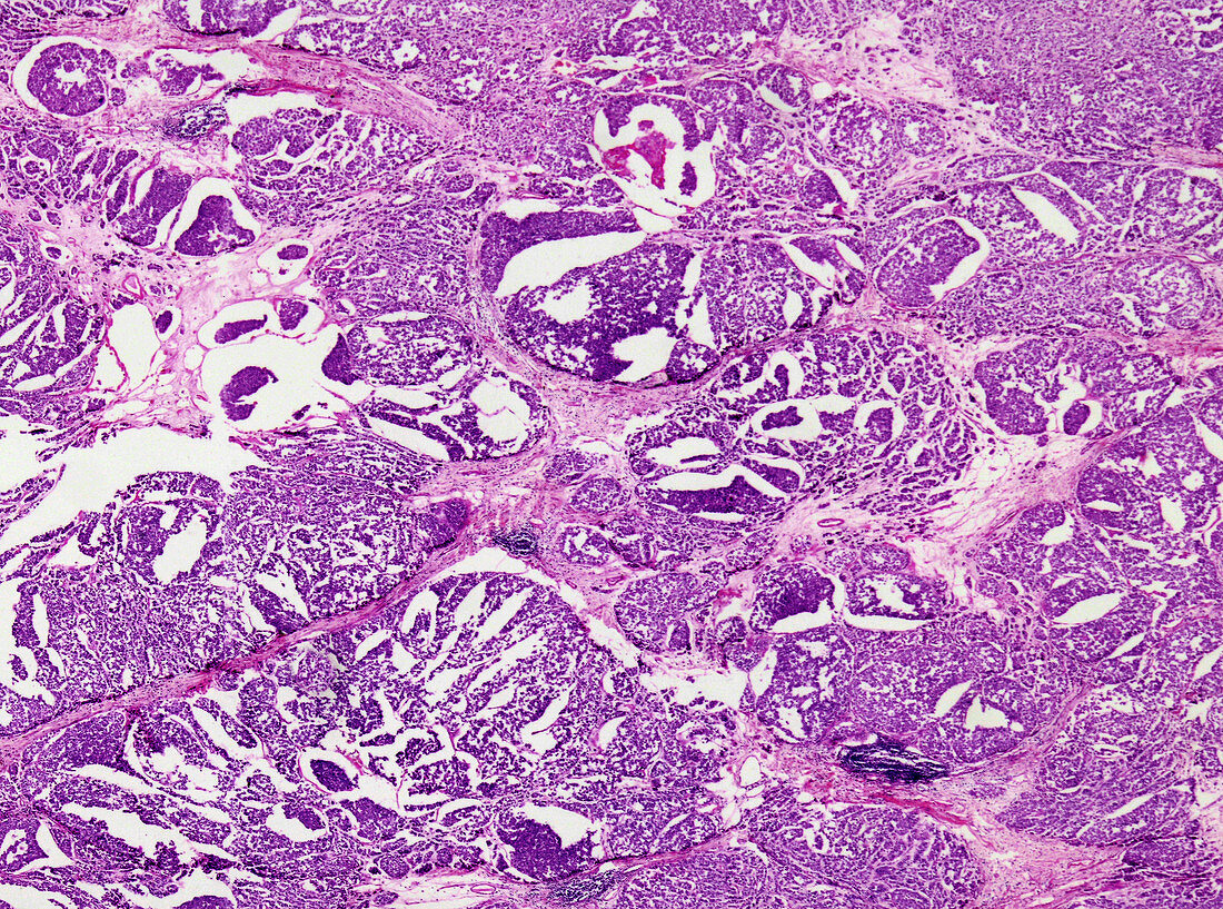 Medullary breast cancer, light micrograph