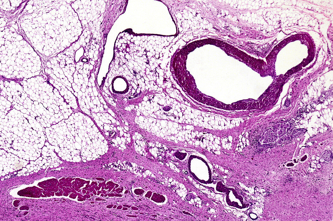 Chronic gastric ulcer, light micrograph
