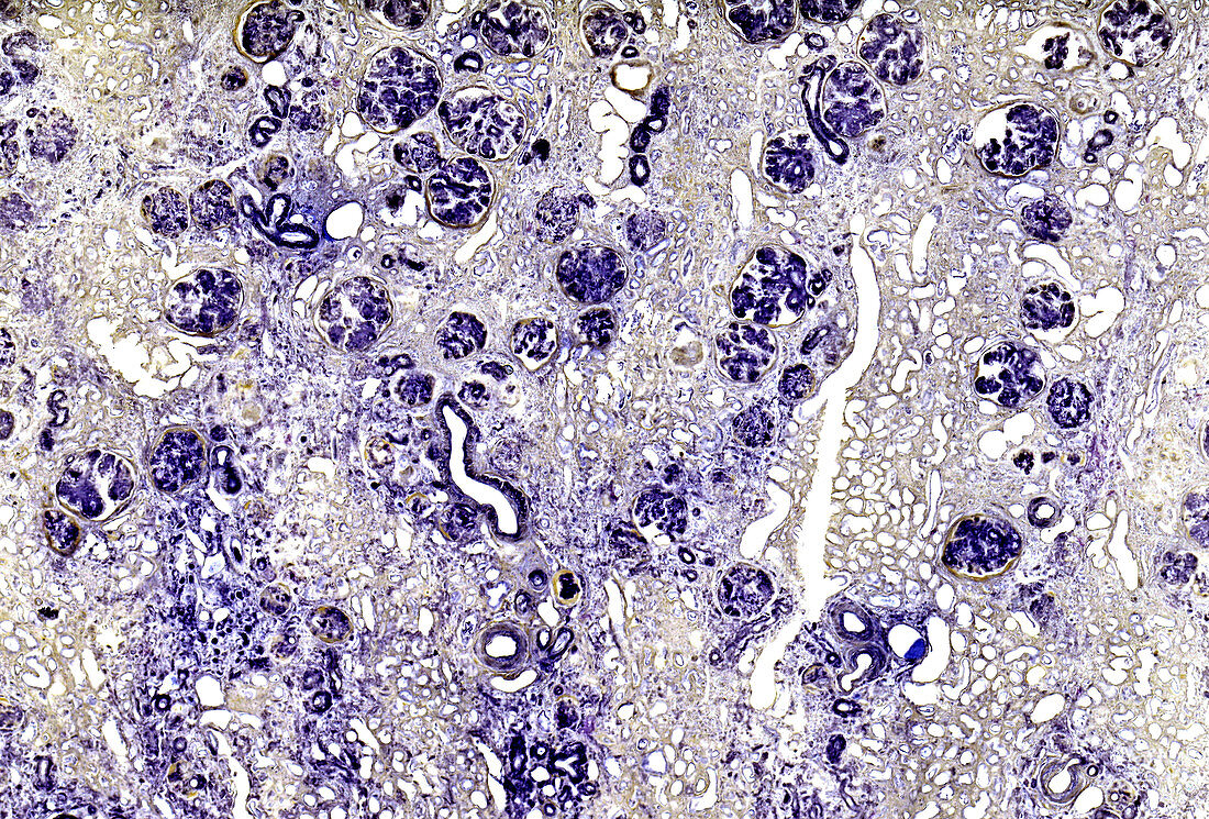 Amyloidosis of the kidneys, light micrograph