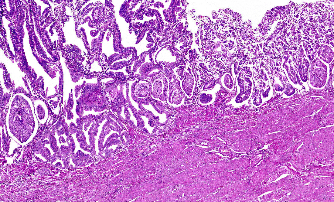 Squamous cell carcinoma of the cervix, light micrograph