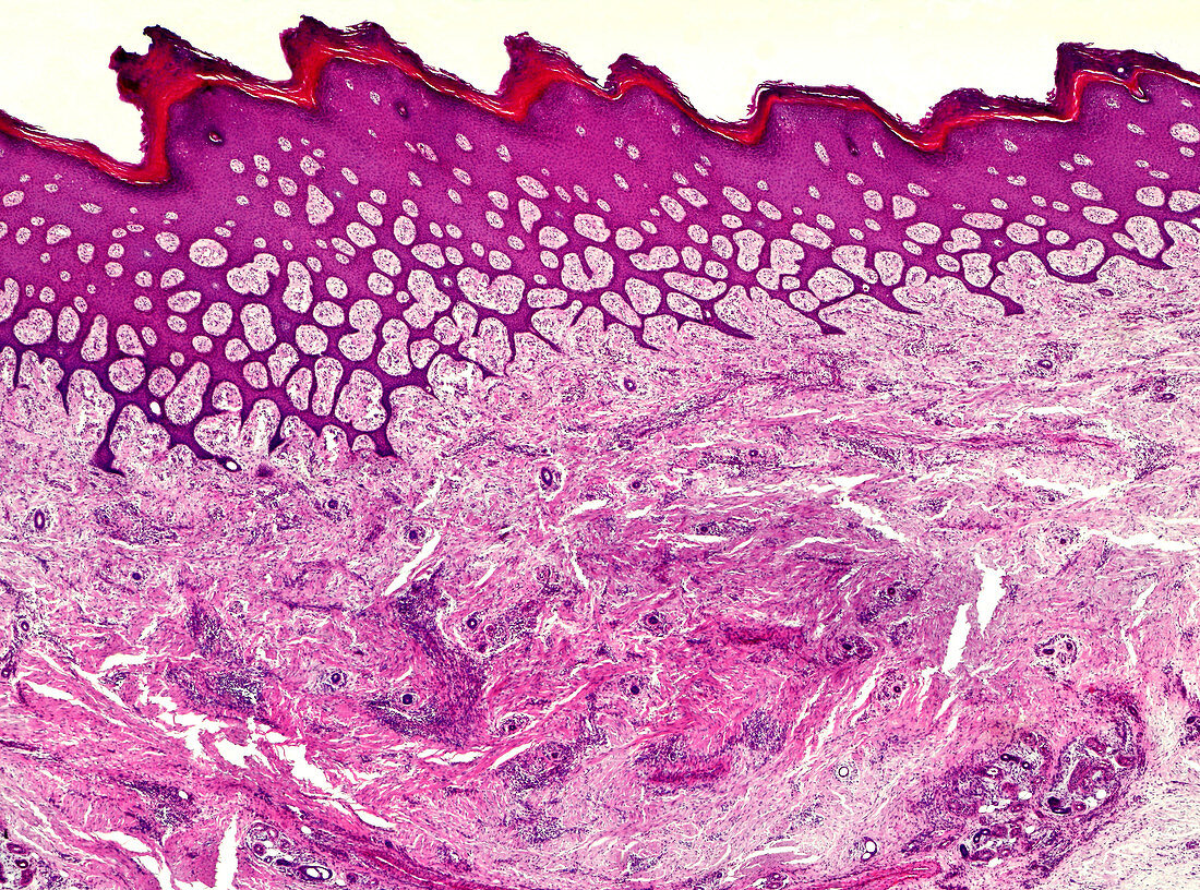 Leprosy, light micrograph