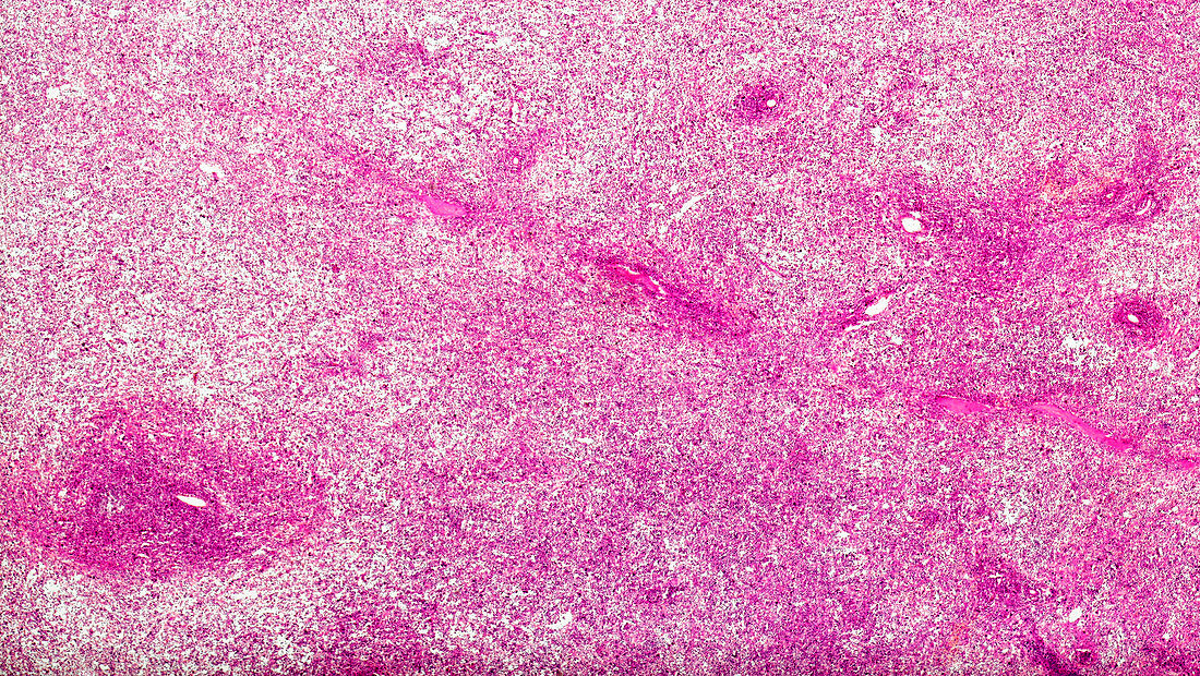 Banti's disease of the spleen, light micrograph